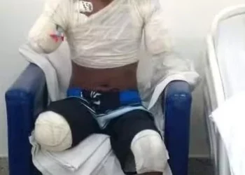 Jovem tem braço e perna amputados após levar choque em fio de alta tensão