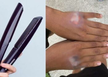 Mãe queima mão do próprio filho em Olinda