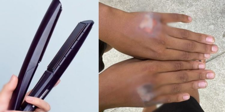 Mãe queima mão do próprio filho em Olinda