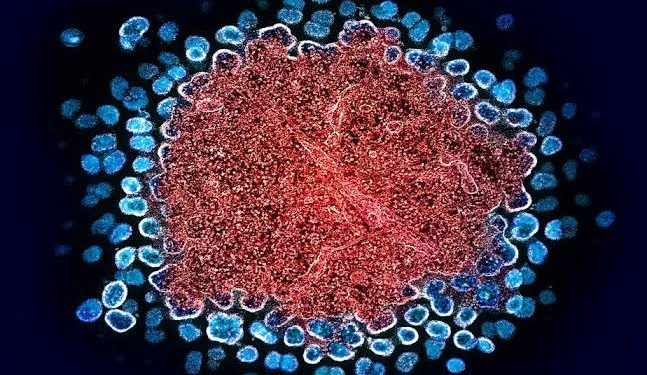 Nova Variante do HIV descoberta no Brasil