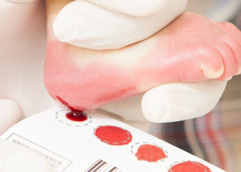 Teste do pezinho em Pernambuco passa a detectar galactosemia