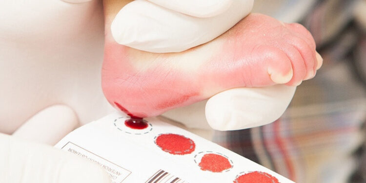 Teste do pezinho em Pernambuco passa a detectar galactosemia