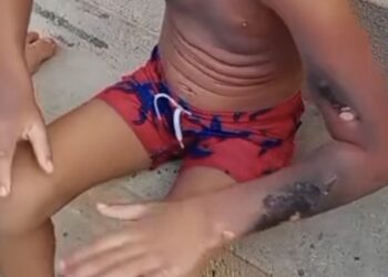 Menino de 6 anos tem corpo queimado após celular explodir